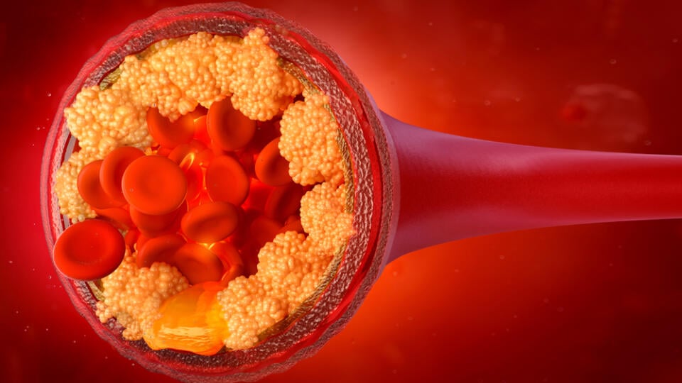 Cholesterol,In,The,Blood,Vessels.,Atherosclerosis,Disease,3d,Illustration:,Atherosclerotic