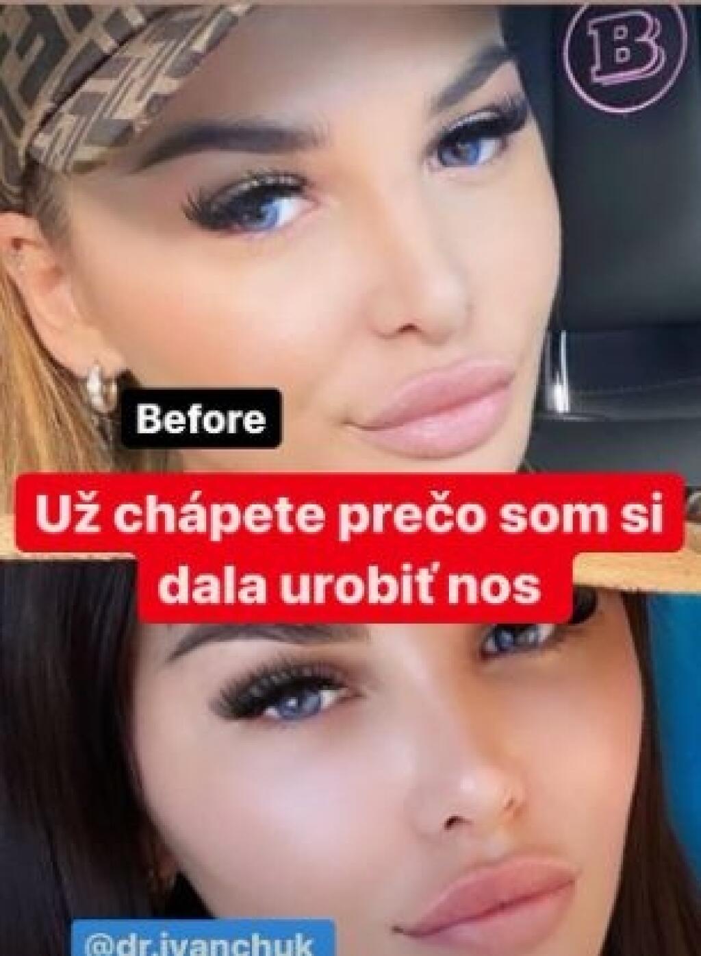 Plačková zverejnila fotku, na ktorej ukazuje, prečo si dala urobiť nos.