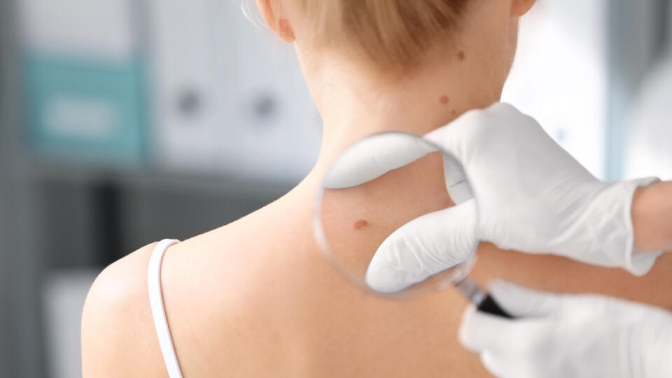 Nebezpečné kožné  znamienka pomôže liečiť imunoterapia. 