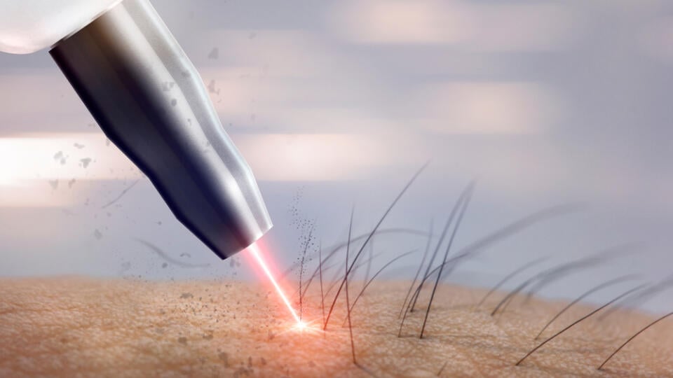 Chĺpky vám na niektorých miestach tela odporučí lekár epilovať zo zdravotného hľadiska.