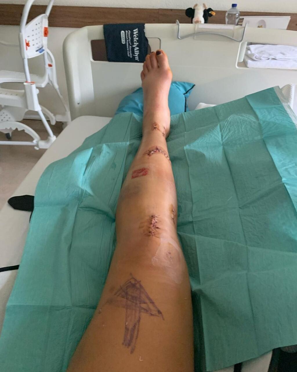 Alice Merryweatherová po tréningu vo švajčiarskom stredisku Saas Fee skončila so zlomenou nohou a skrvavenou tvárou.