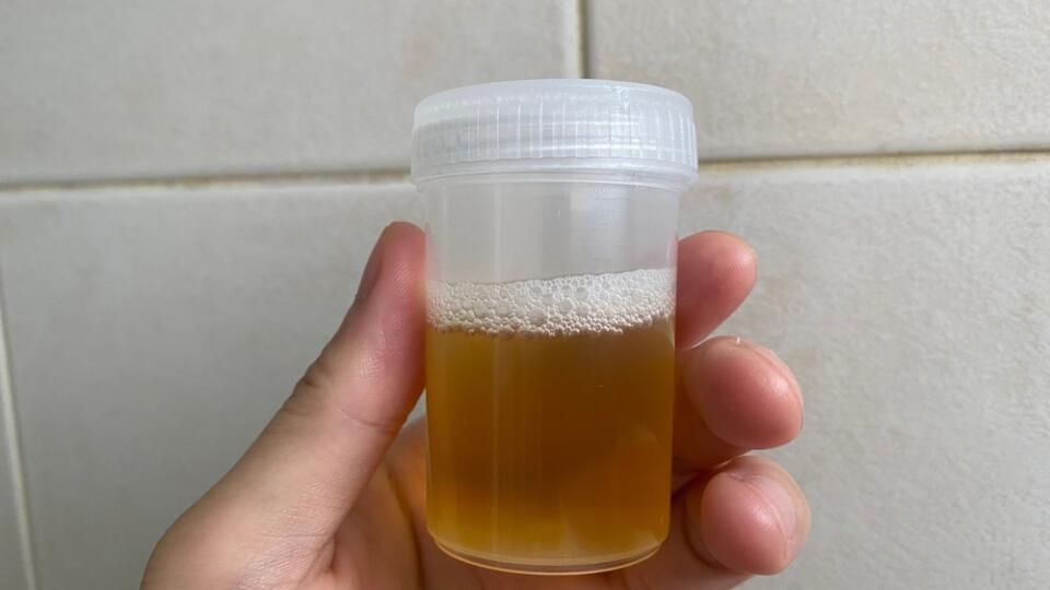 Urine,Collection,In,Plastic,Bottle,For,Medical,Laboratory,Exam,,Held