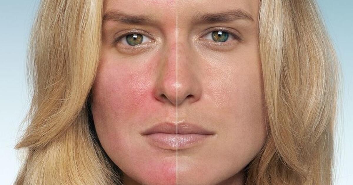 Почему красное лицо постоянно у женщины. Чувствительная кожа лица. Цианотичный оттенок лица.