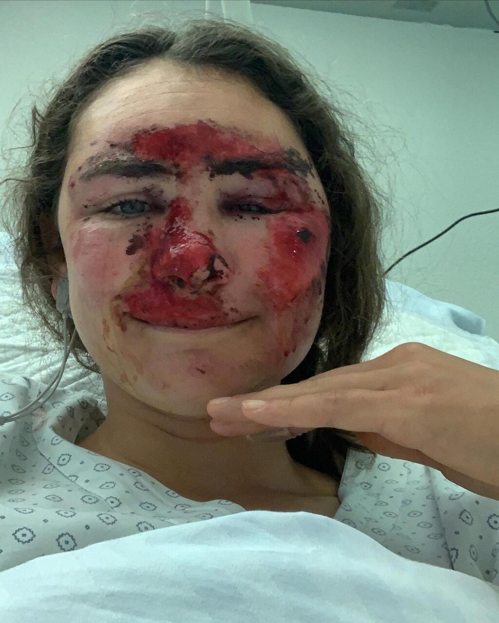 Alice Merryweatherová po tréningu vo švajčiarskom stredisku Saas Fee skončila so zlomenou nohou a skrvavenou tvárou.