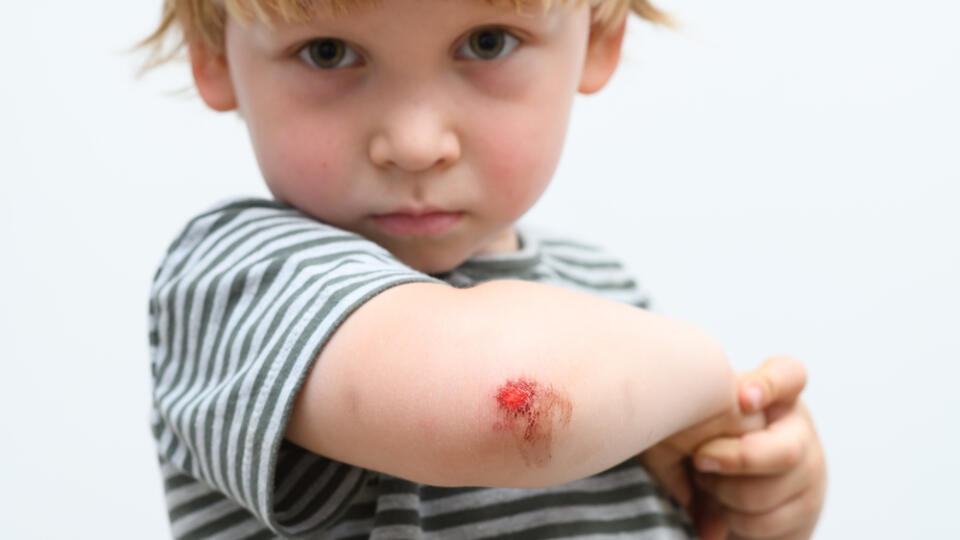 Boy,Kid,Arm,Accident,Wound,He,Painful,Abrasion,Scratches,From