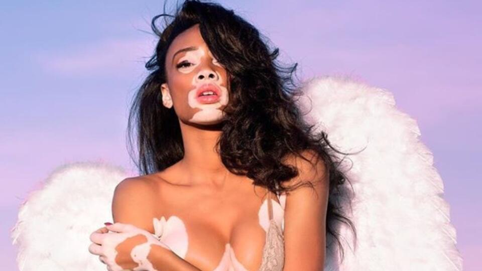 Winnie Harlow trpí chorobou zvanou vitiligo. V detstve si pre svoju fľakatú pokožku veľa vytrpela, no posmeškom a šikane nepodľahla. Rozhodla sa všetkým ukázať, že aj inakosť môže byť krásna.