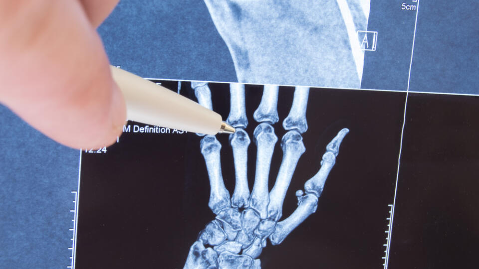 X-ray,Scan,Of,Hand,,Bones,And,Finger,Joints.,Doctor,Pointed